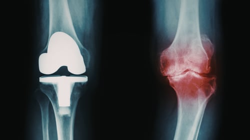 Stem Cell Therapy for Knee Osteoarthritis: An Alternative to Knee Replacement featured image