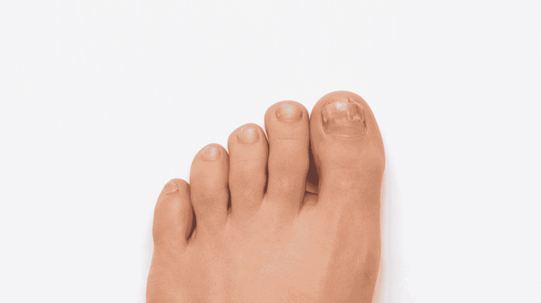 Fungal Nail Infection: Causes, Symptoms and How to Treat It Featured image
