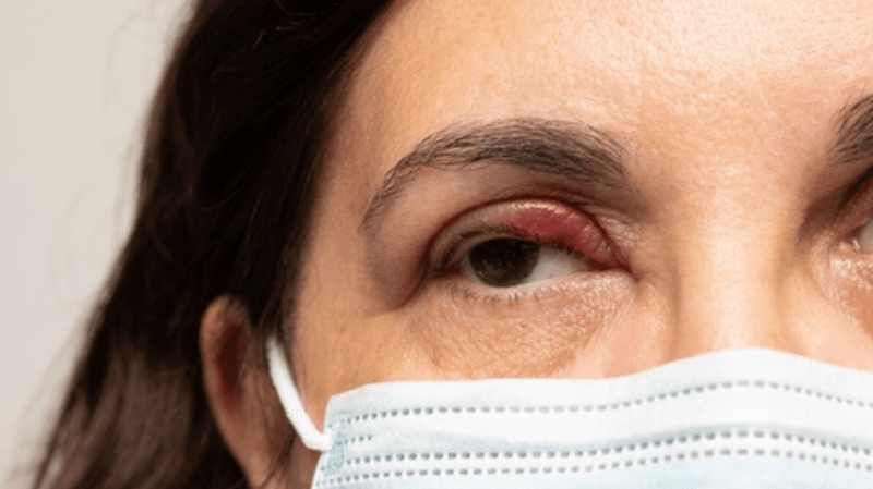 A woman with styes