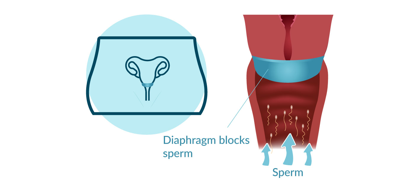 Diaphragm - Types of Contraceptives in Hong Kong