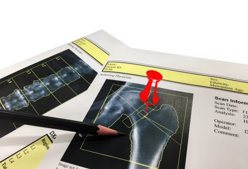 Dexa Scan