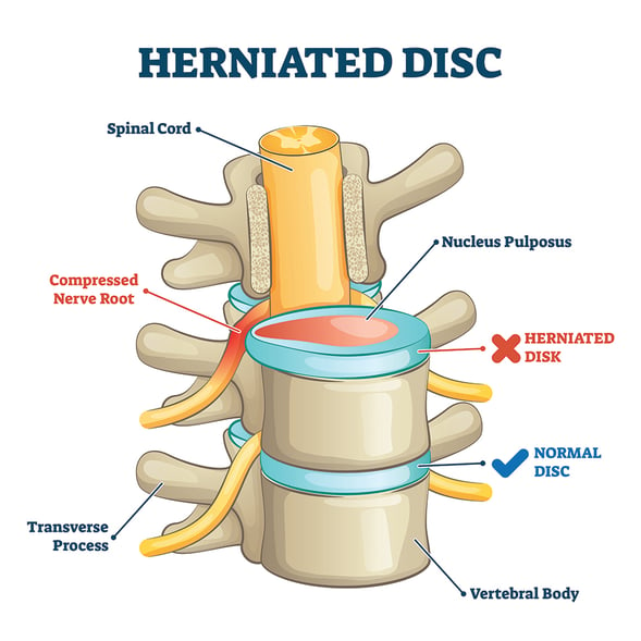 Herniated disc