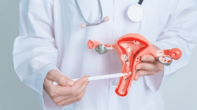 ovarian cancer