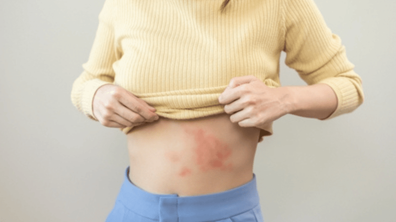 Shingles