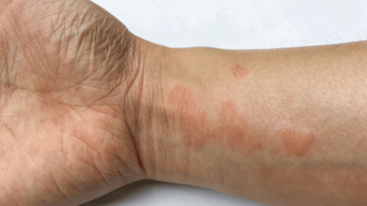 Systemic lupus erythematosus 