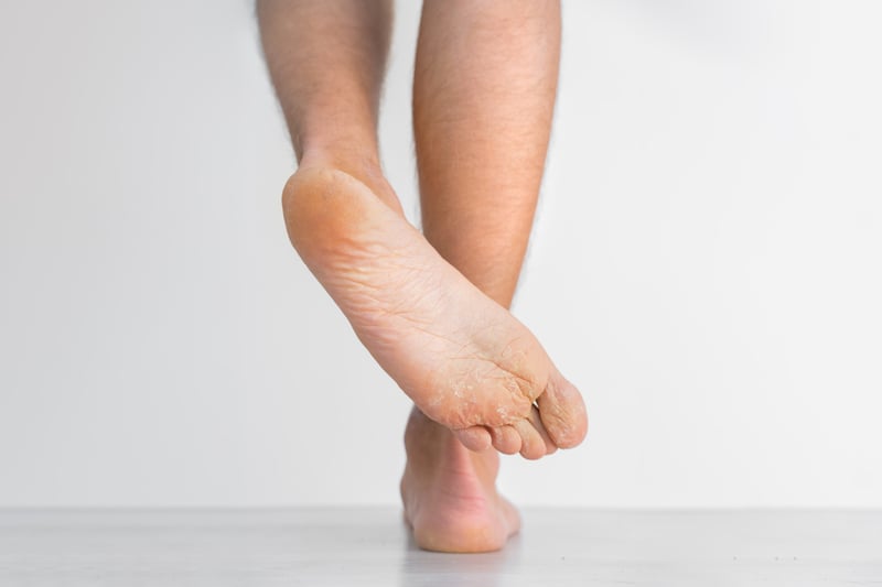 Athlete foot