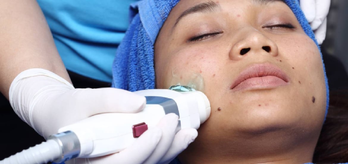 正在進行hifu療程的女性