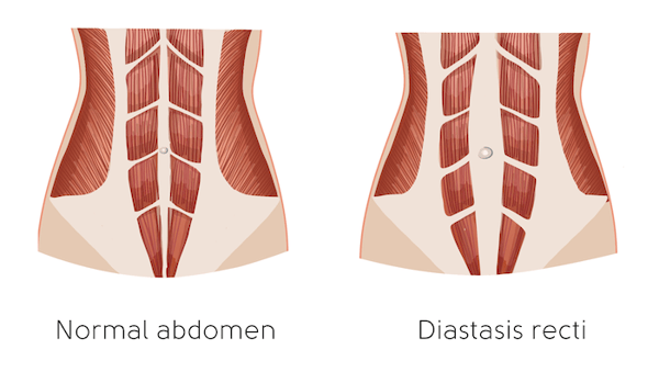 diastasis recti infographic