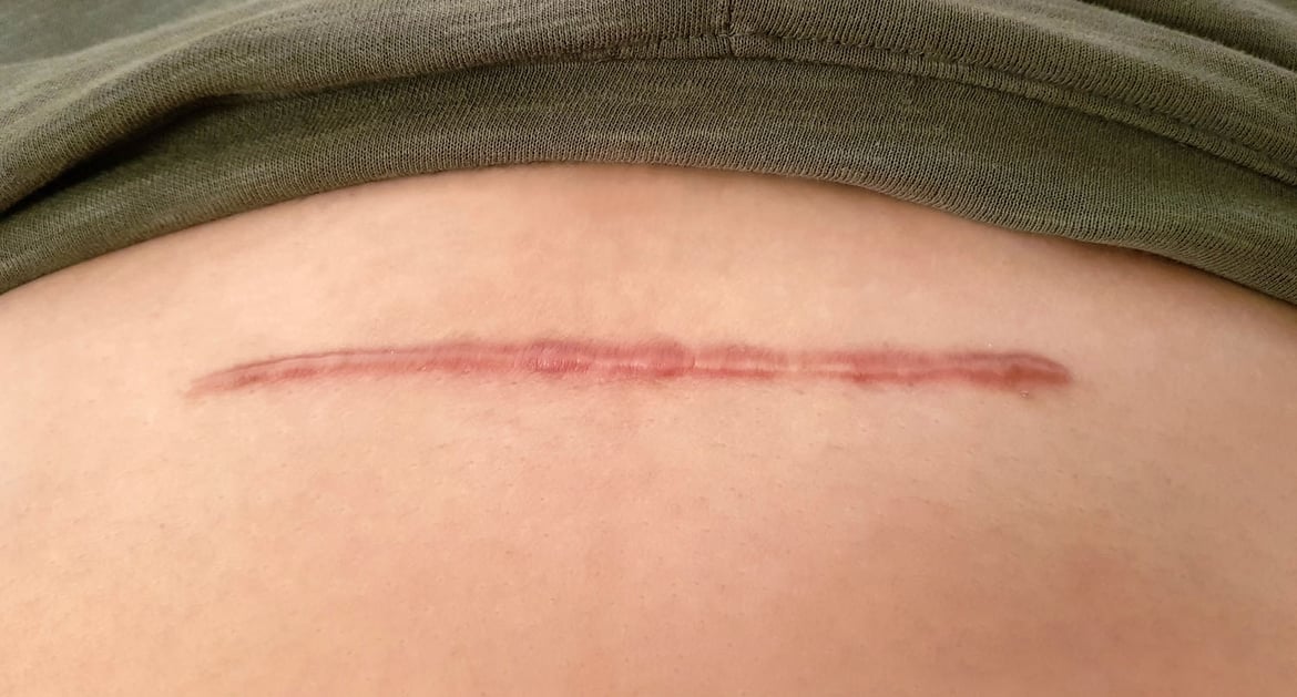 A keloid scar on the belly