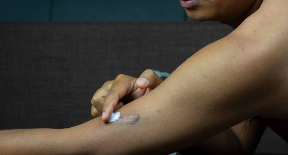 蟹足腫患者在傷口塗藥膏