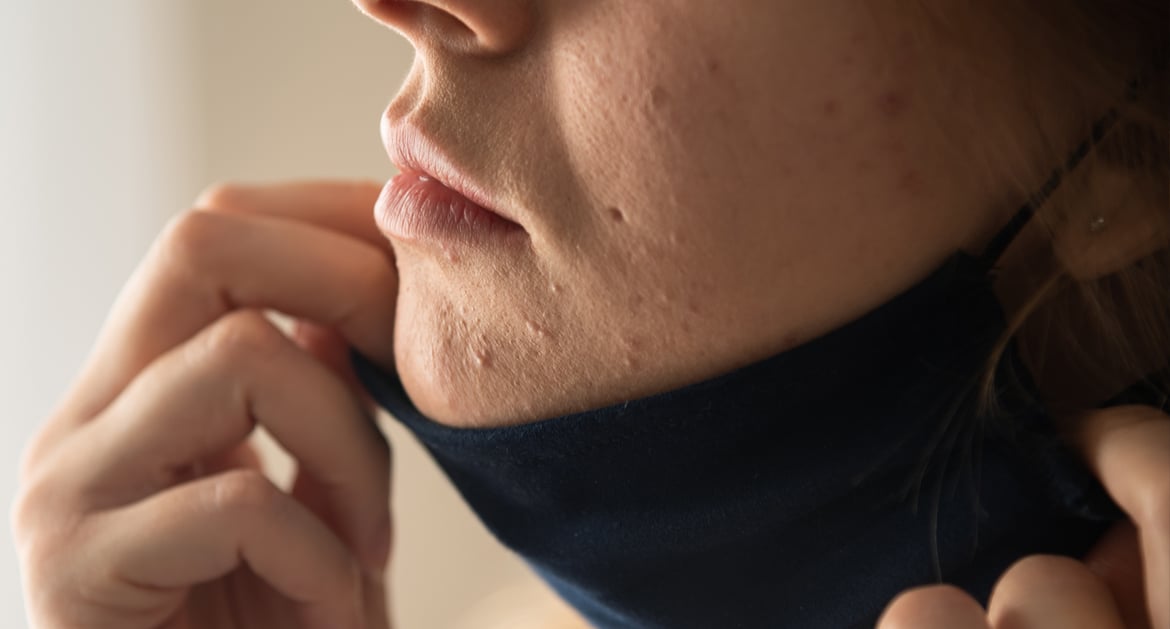 長期佩戴口罩後面部生暗瘡