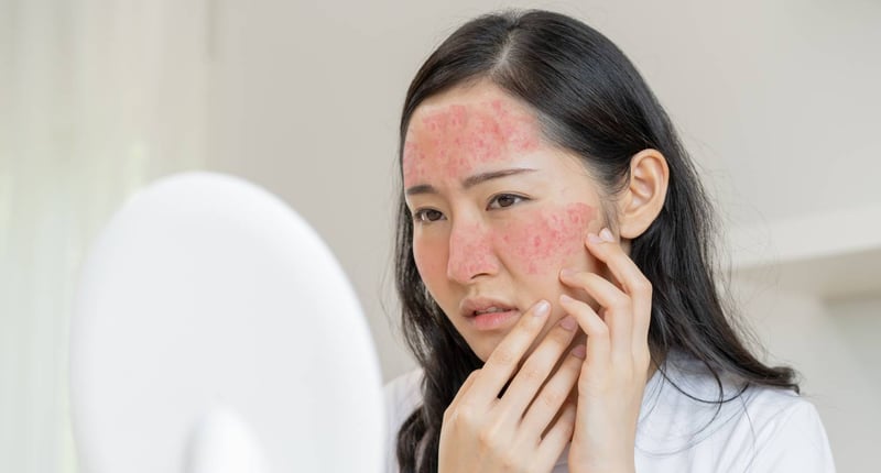 患有玫瑰痤瘡的年輕女性