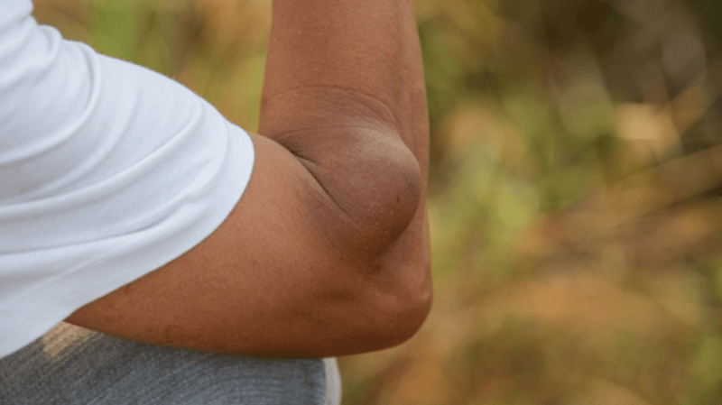 A lump on the arm