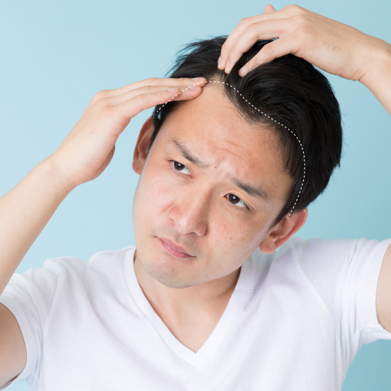 img-hair-loss-asian-male-hairline