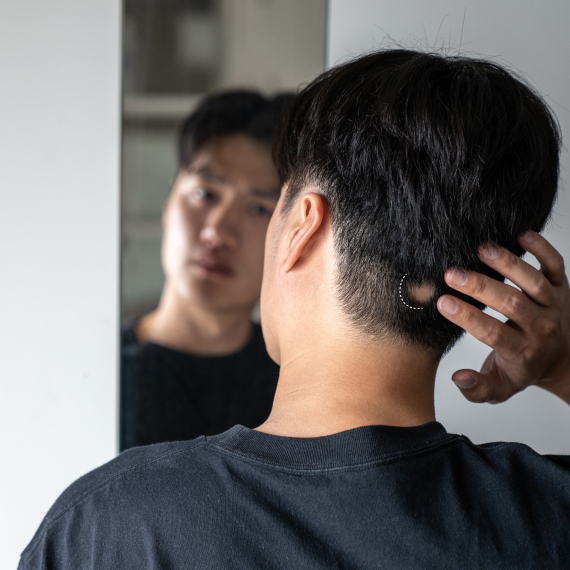 img-hair-loss-asian-male-alopecia-areata
