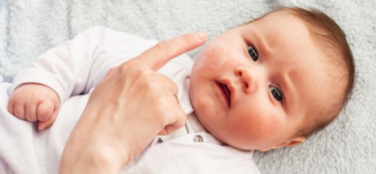 家長為患濕疹BB塗抹藥膏