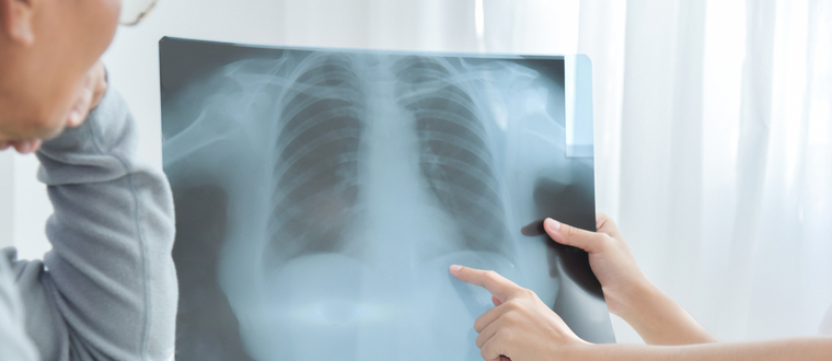 肺癌X光檢查