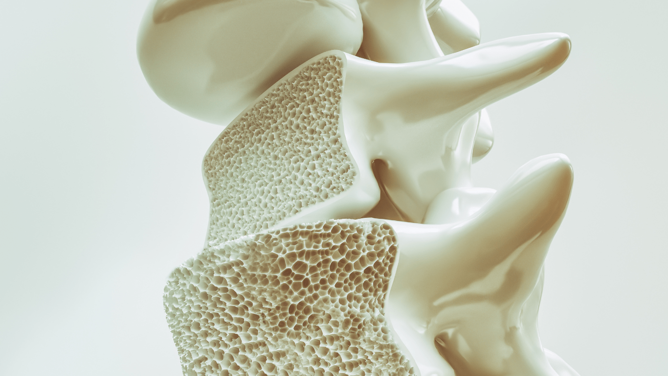 Osteopenia to Osteoporosis