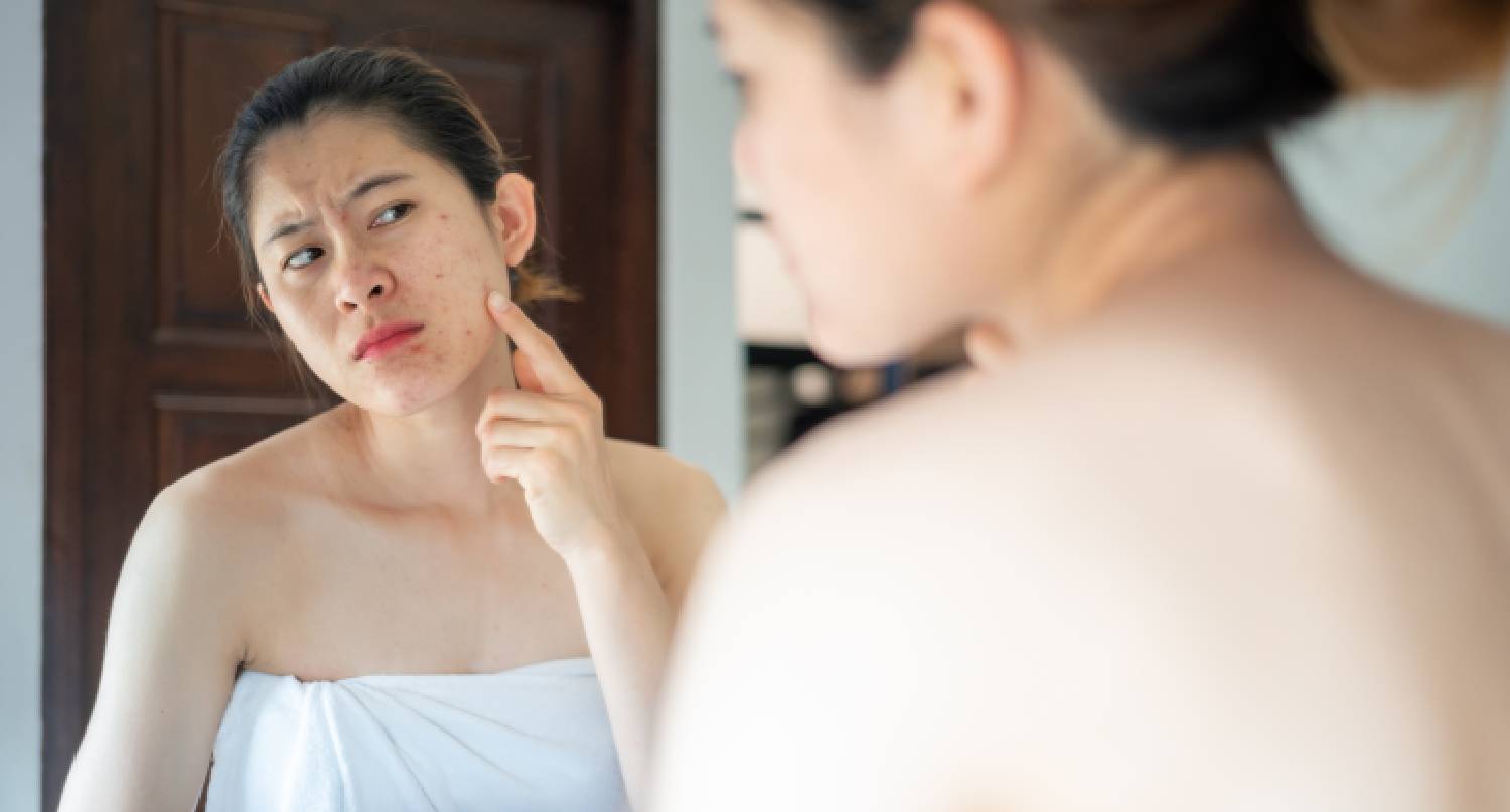 年輕女性擔心面上暗瘡