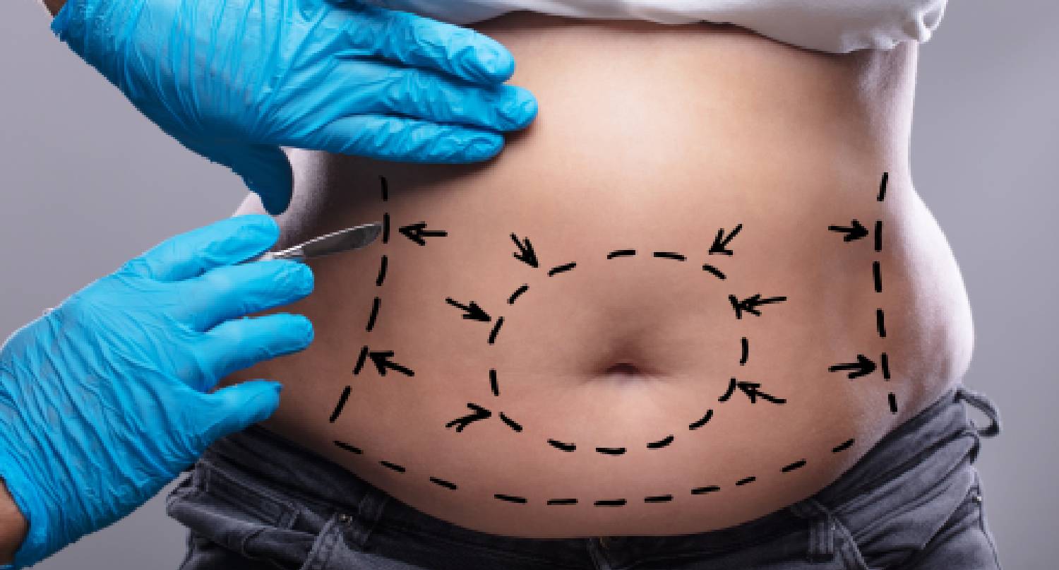 醫生在手術中量度需抽取的脂肪