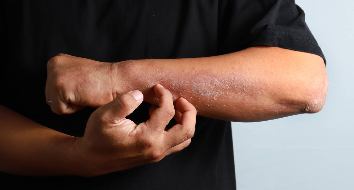 患有濕疹的手臂