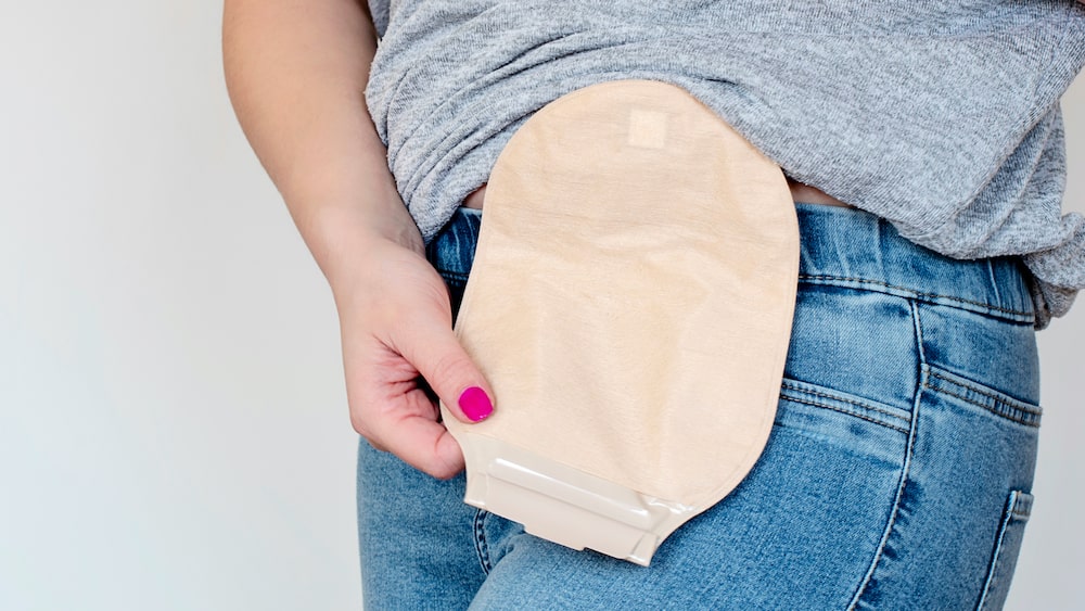 women with a colostomy pouch