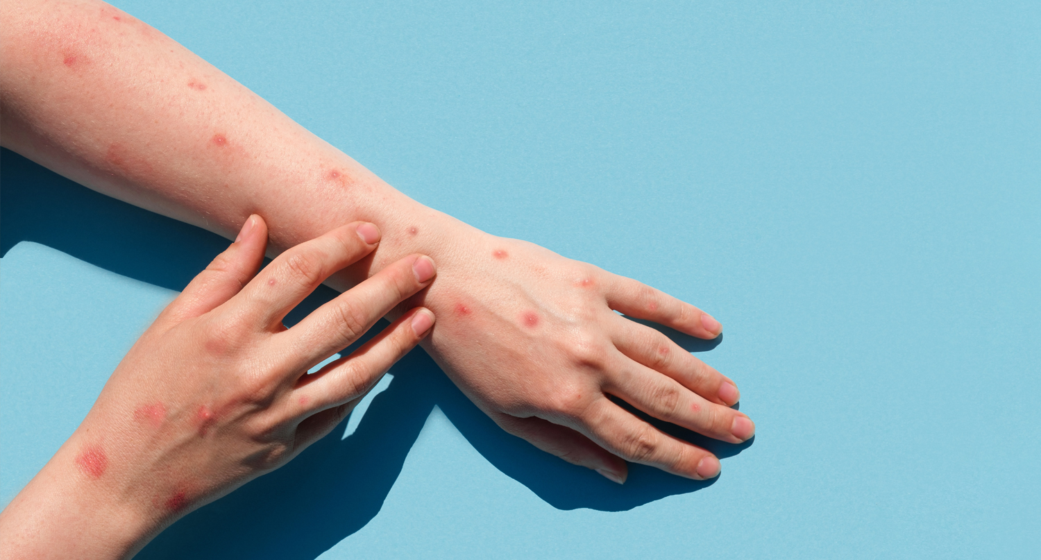 猴痘患者的手臂