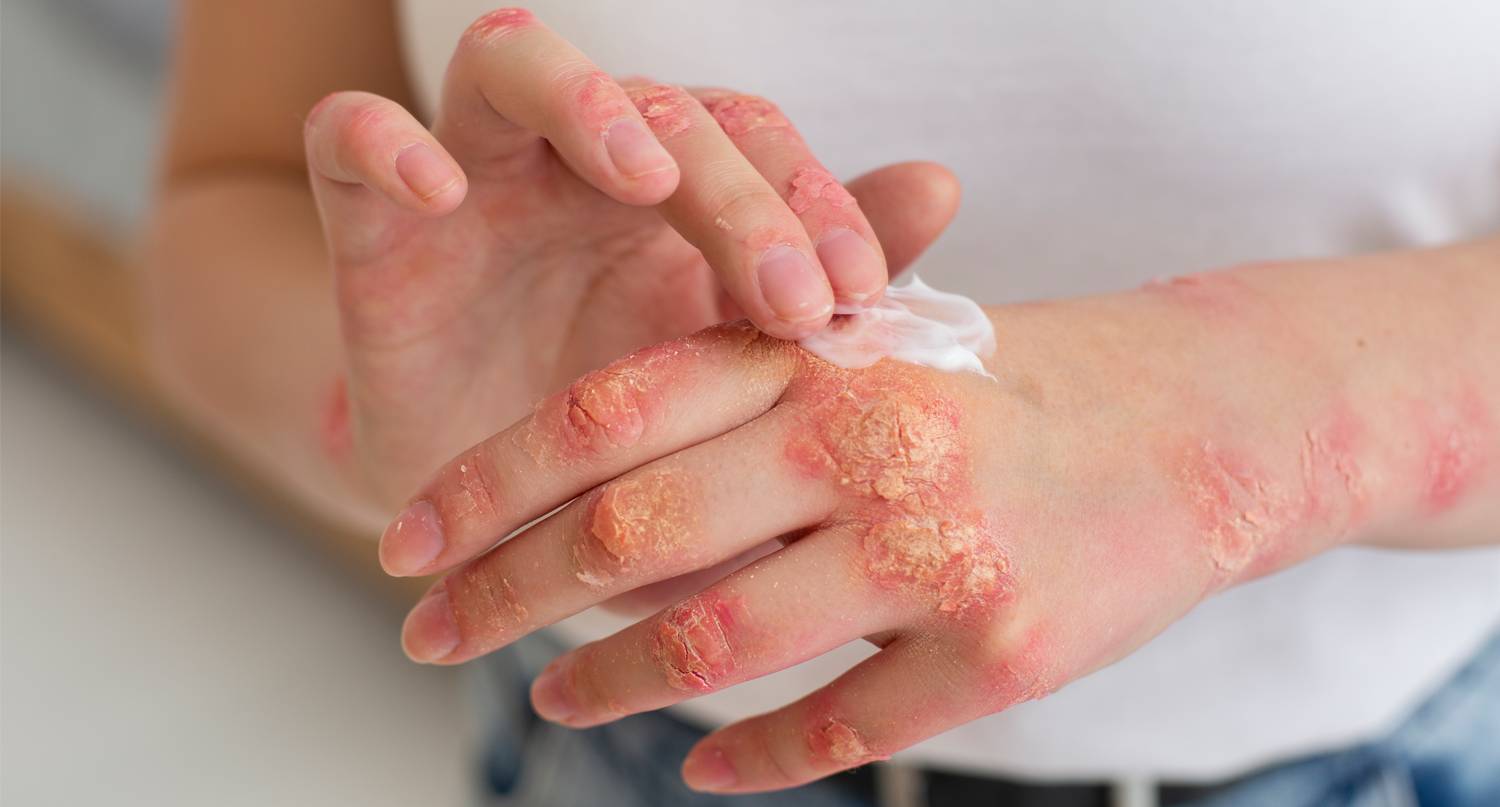 牛皮癬患者塗抹護膚膏