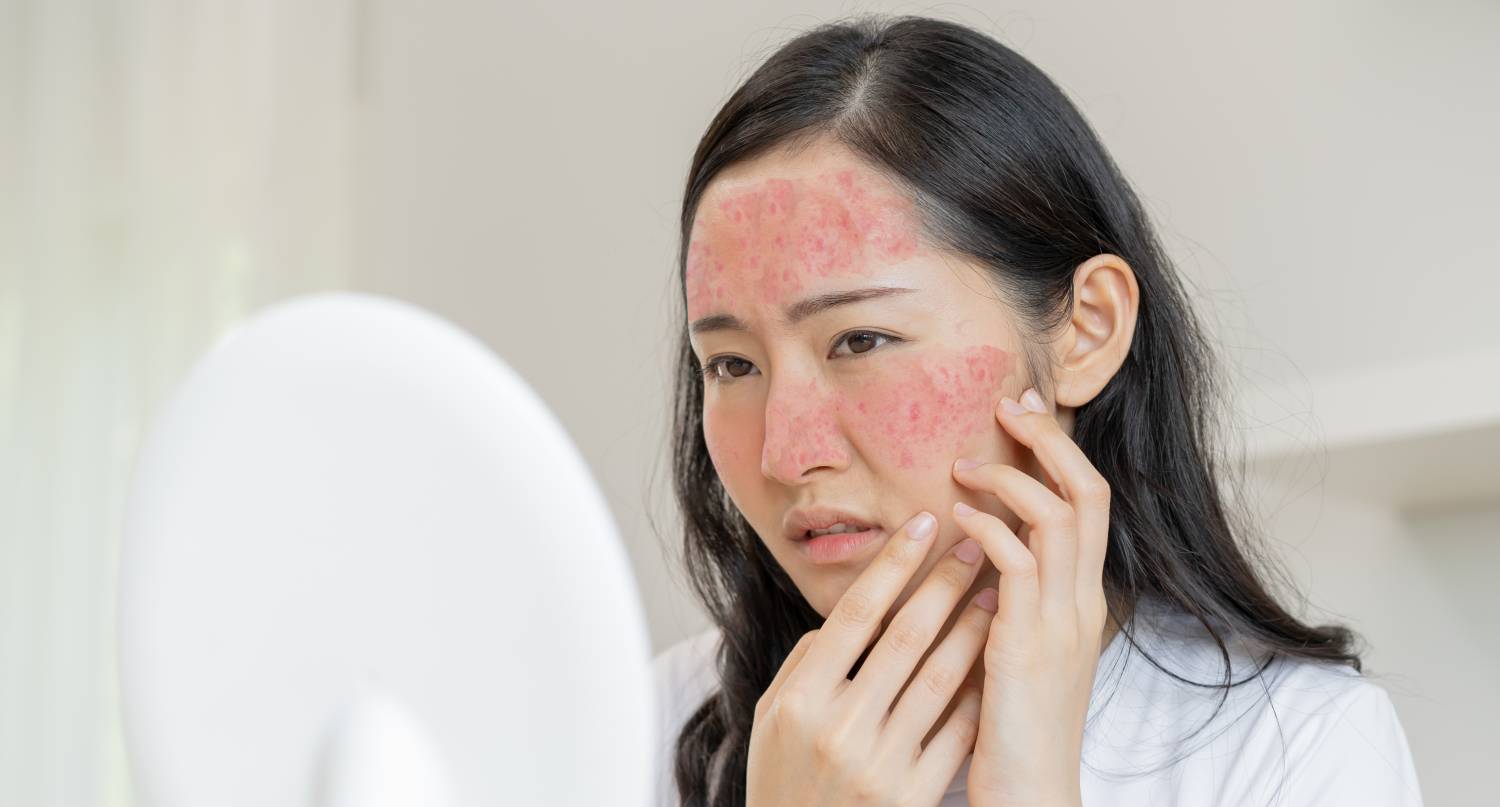 An young woman with rosacea